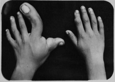 Seven-fingered hand cast mirror hand, 1853 [WAM 00917] - Digital