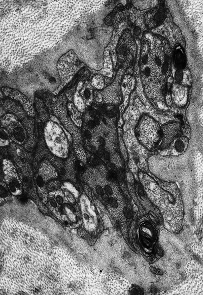 Axon in corneal stroma with mitochondria