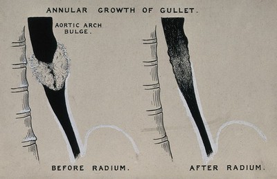 Radium