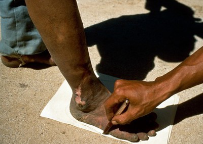 Leprosy: physical and social management