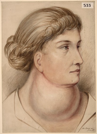 Large Goitre In A Woman Europeana