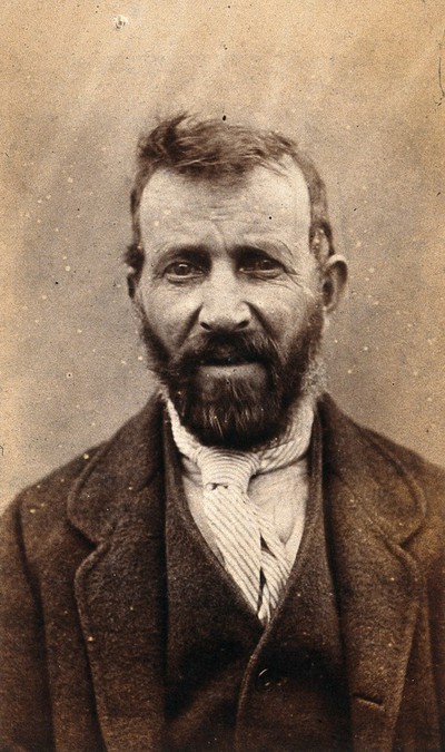 West Riding Lunatic Asylum in Wakefield, Yorkshire: a bearded man; head ...