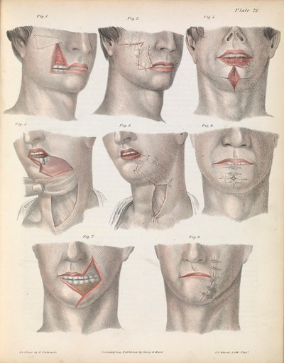 Primary Cheiloplasty using the Technique of Millard - Semantic Scholar